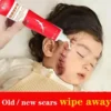 Acne Scar Removal Cream Pimples Surgical Scar Stretch Marks Face Gel Remove Smoothening Whitening Body Skin Care Creme