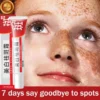 Effective Whitening Freckles Face Cream Remove Melasma Dark Spots Fade Melanin Acne Scars Anti-aging Brighten Repair Skin Care - Image 4