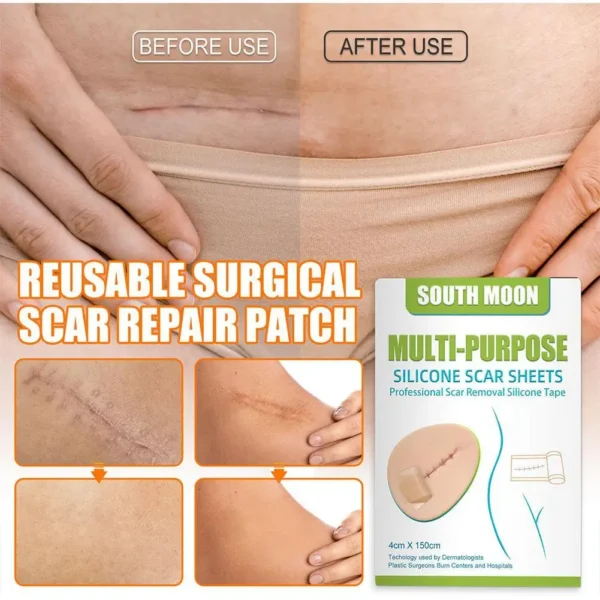 2pcs 150cm Silicone Gel Scar Sheet Patch Treatment Removal Tape Acne Trauma Burn Scar Cover Skin Repair Section Ear Beauty - Image 3