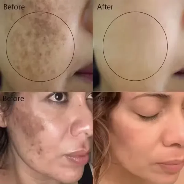 Vitamin C Whitening Freckles Serum Remove Dark Spots Freckles Fade Melanin Nicotinamide Essence Brighten Moisturizing Skin Care - Image 2