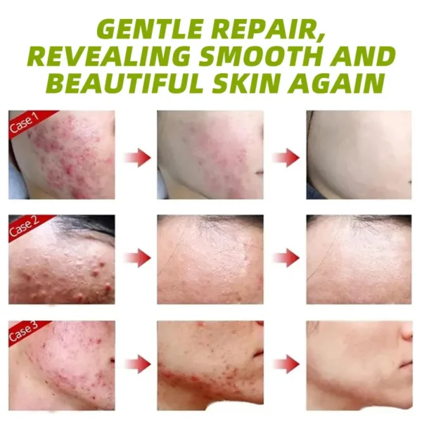 30g Acne Cream soothes, hydrates, helps regulate oil, reduces redness, and enhances skin texture with a moisturizing feel - Image 2