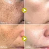 Effective Whitening Freckles Face Cream Remove Melasma Dark Spots Fade Melanin Acne Scars Anti-aging Brighten Repair Skin Care - Image 3