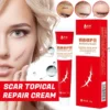 Acne Scar Removal Cream Pimples Surgical Scar Stretch Marks Face Gel Remove Smoothening Whitening Body Skin Care Creme - Image 2